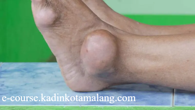 Waspada Ciri-Ciri Asam Urat Tinggi pada Wanita dan Cara Mengendalikannya