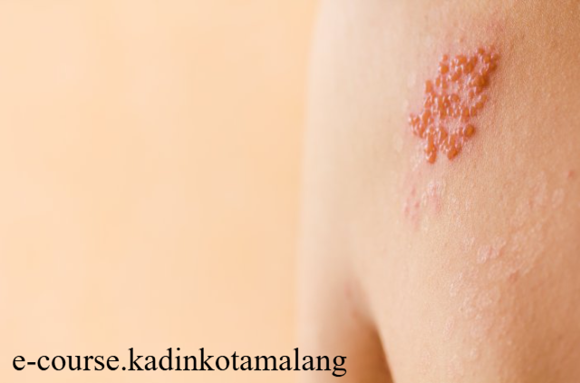 Mencegah Herpes Penyebab Utama dan Cara Paling Efektif