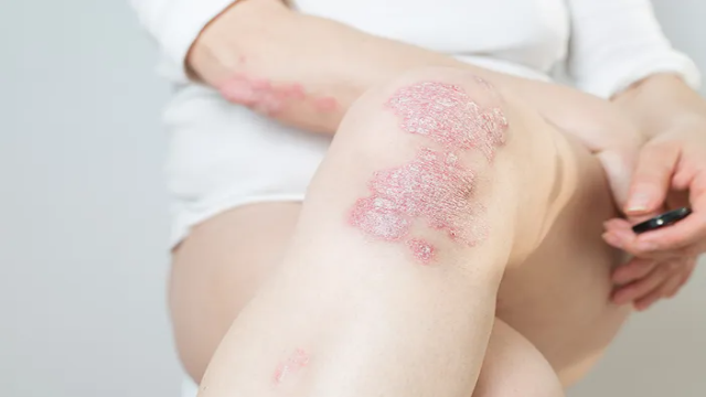 Tips Perawatan Kulit untuk Penderita Psoriasis
